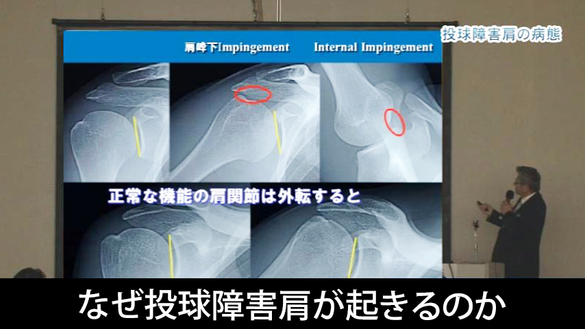 なぜ投球障害肩が起きるのか？～ 病態から考える治療展開と、予防のためのコンディショニング ～