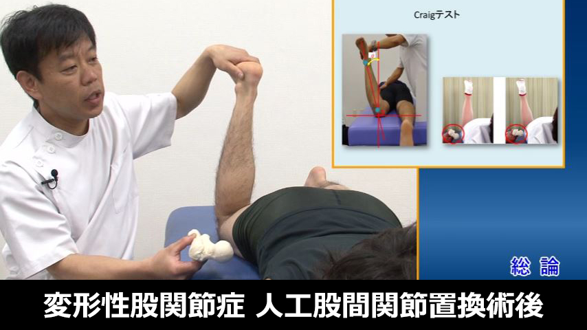 変形性股関節症に対する人工股関節置換術後の理学療法